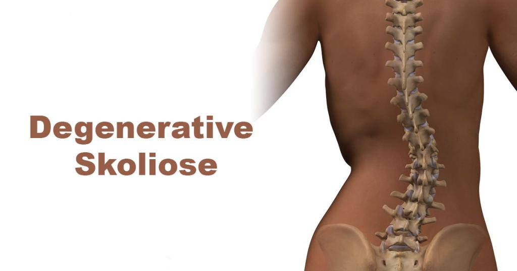 Degenerative Skoliose