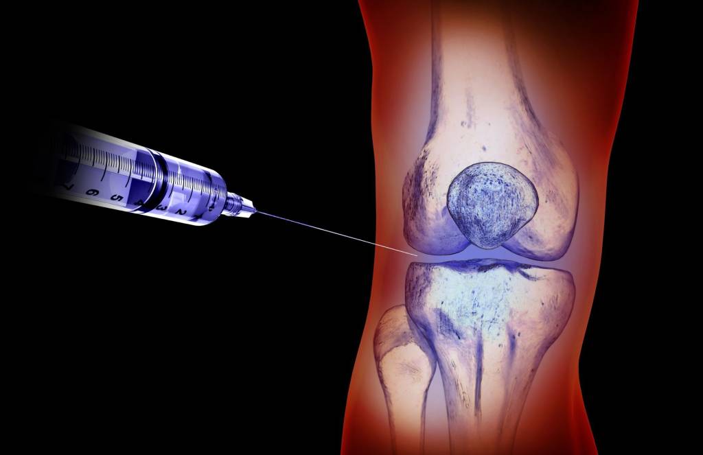 Hyaluronsäure bei Arthrose