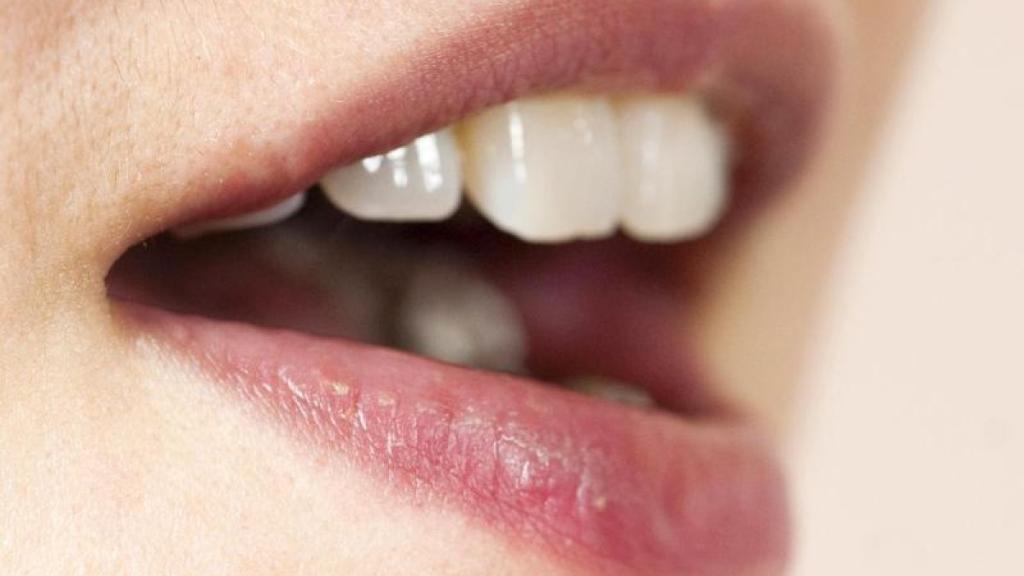 Tipps gegen Herpes Labialis (Lippenherpes) - Wie-funktioniert.com Tipps gegen Herpes Labialis (Lippenherpes) - Wie-funktioniert.com