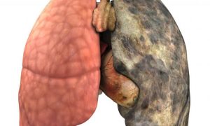 COPD - Chronisch Obstruktive Bronchitis