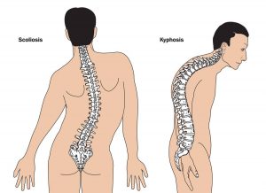 Die neuromuskuläre Skoliose