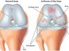 Hilfe bei Arthrose –  Krankheitsbild und Therapie bei Gelenkerkrankungen