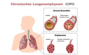 Chronisches Lungenemphysem - COPD