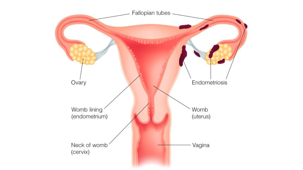 endometriose symptomen endometriose symptomen
