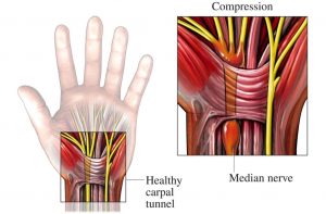 Karpal-tunnel