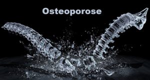 Knochenschwund Osteoporose