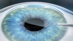 Lasik