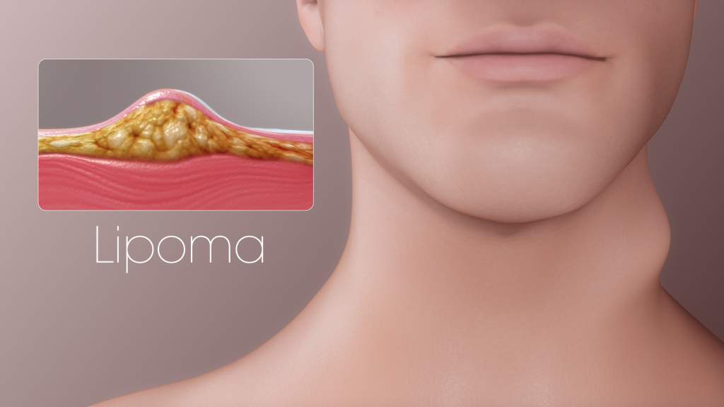 lipoma-10-causes-of-lipoma