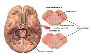 Morbus Parkinson