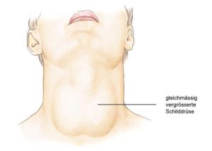 Schilddrüsenerkrankungen