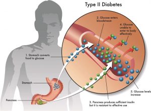 diabetes-type-2