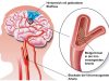 Schlaganfall: Ursachen, Symptome, Erkennung und Behandlung
