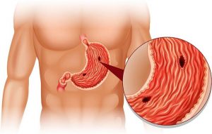 Chronische Gastritis