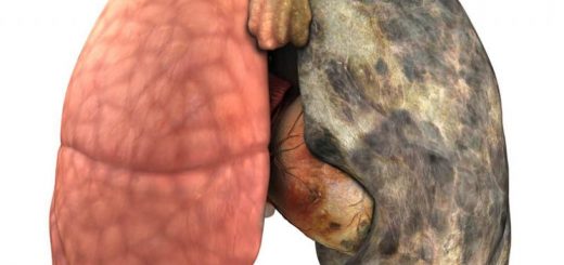 Morbus Bechterew Chronische Wirbelsäulenentzündung