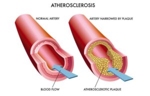 Arteriosklerose