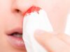 Ursachen und Behandlung von Nasenbluten