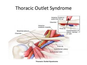 thoracic-outlet-syndrome